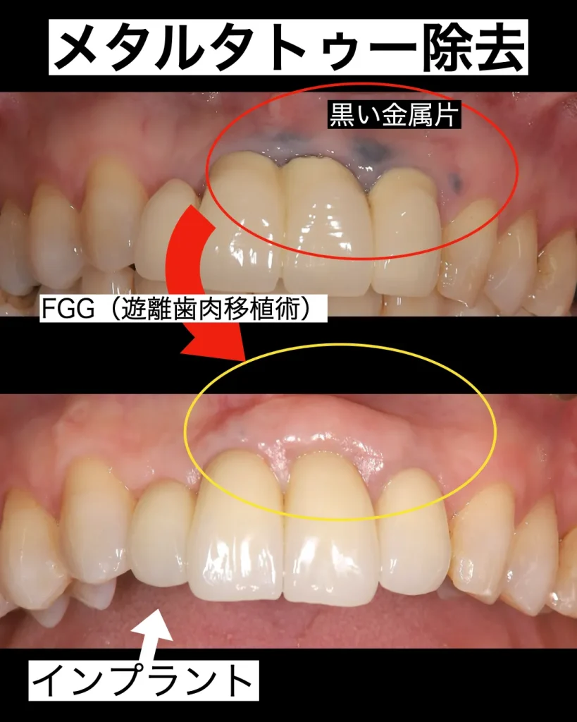 メタルタトゥー