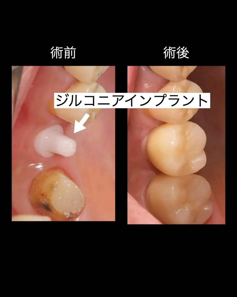 ジルコニアインプラントが入った状態

