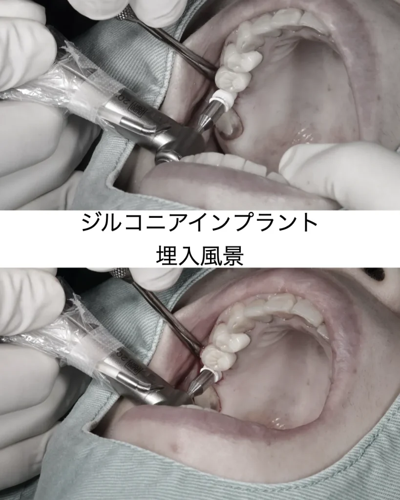 ジルコニアインプラント埋入途中
