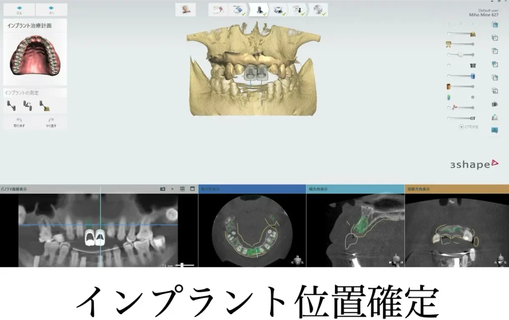 サージカルガイドの作成
