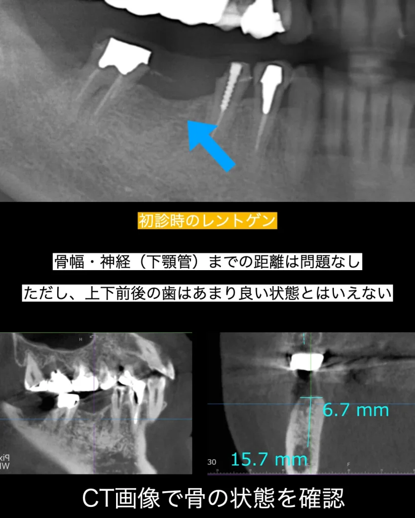 初診時のレントゲン