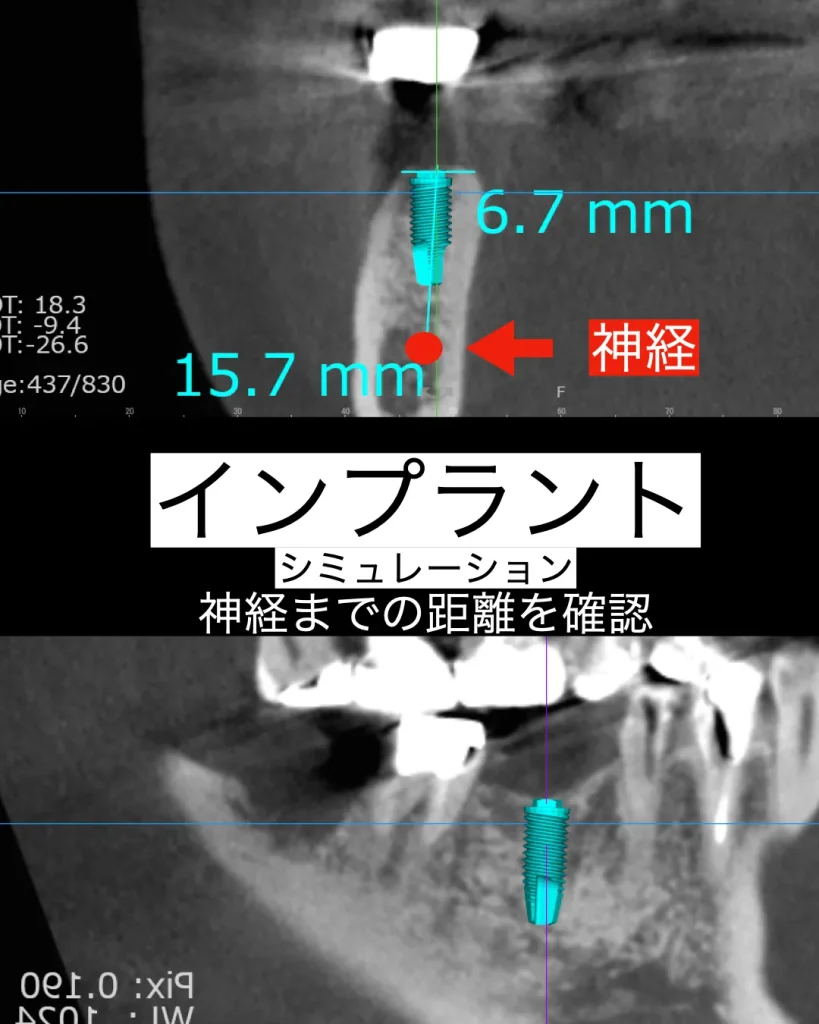 インプラントの位置とシミュレーション