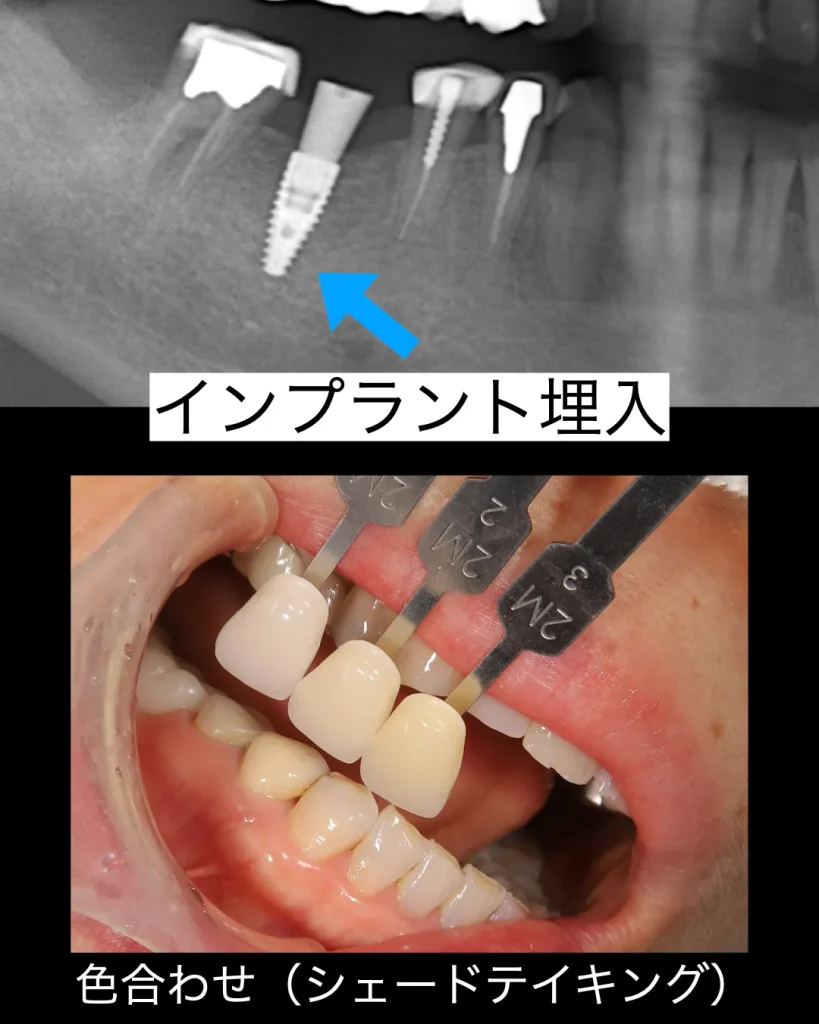 インプラント埋入