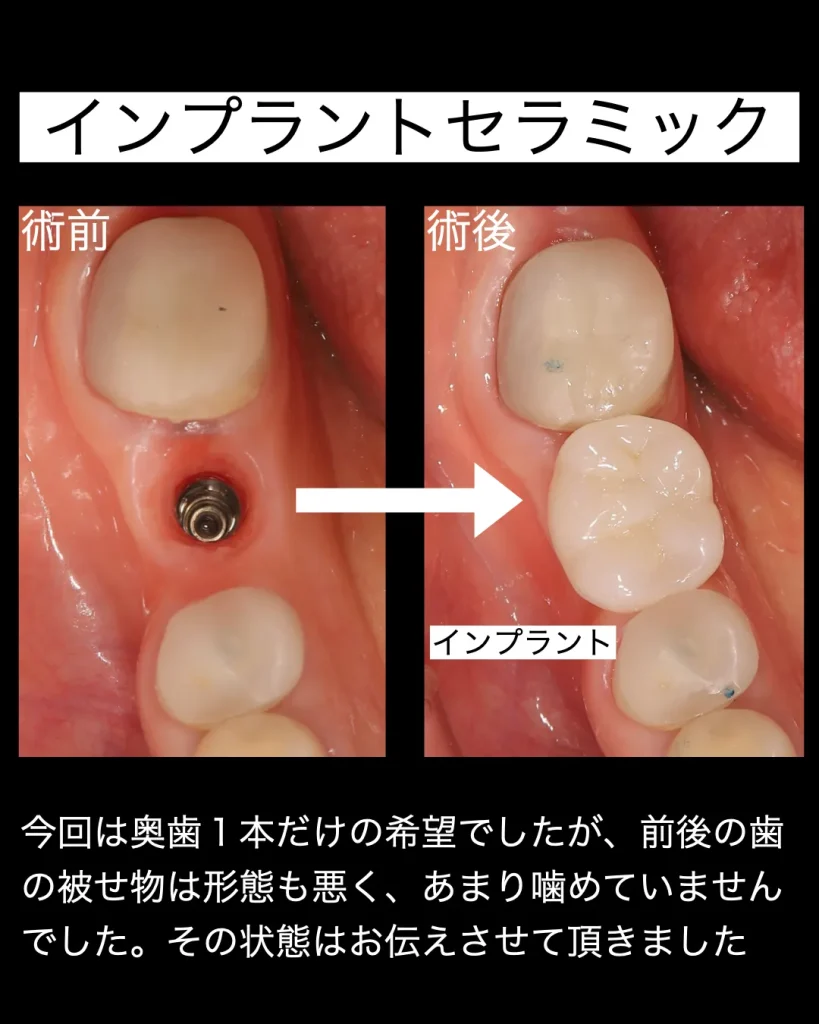 インプラントセラミック