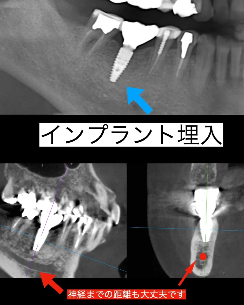 インプラント埋入後のレントゲン写真