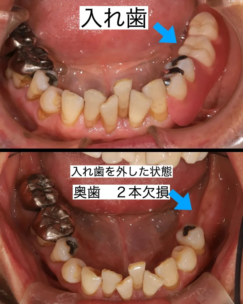 入れ歯からインプラントへ 患者様の「これからの人生」を支えるために