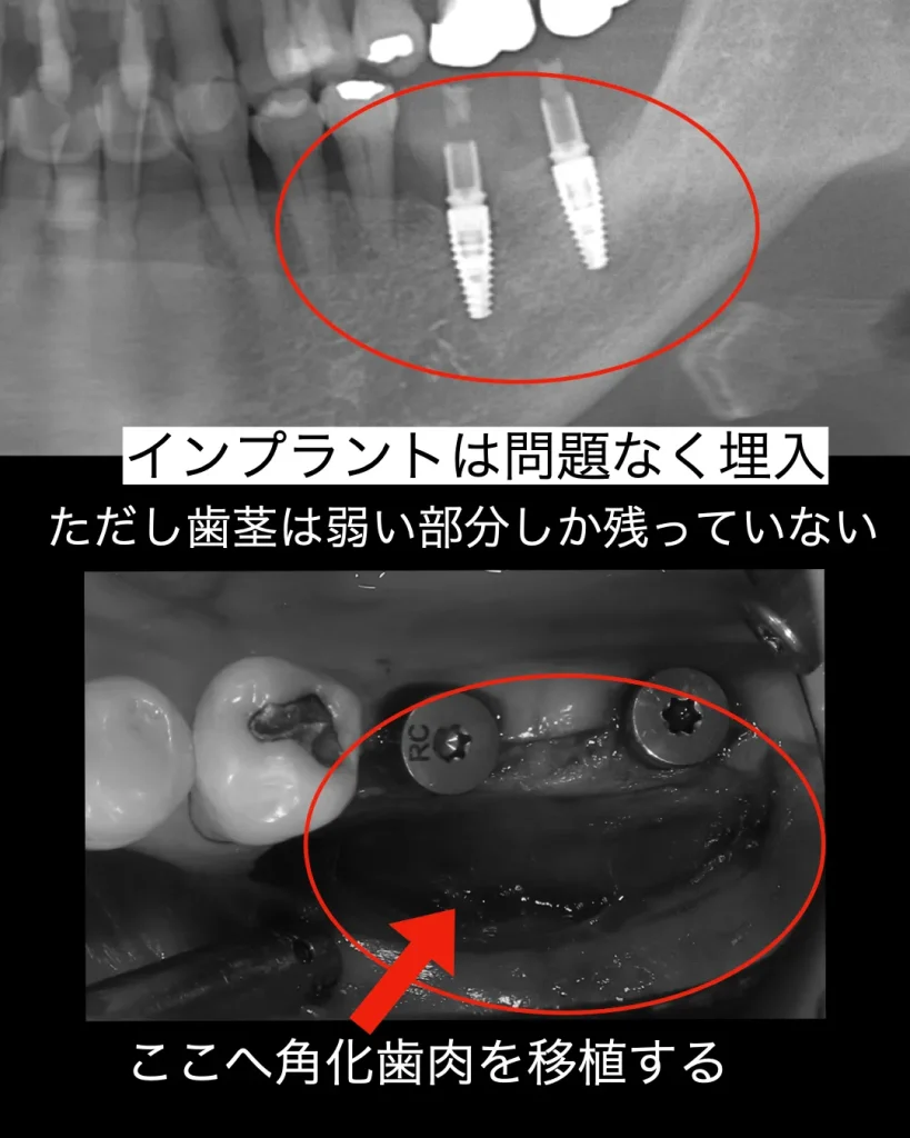 綿密なシミュレーションとサージカルガイドを活用することで、理想的な位置にインプラントを埋入