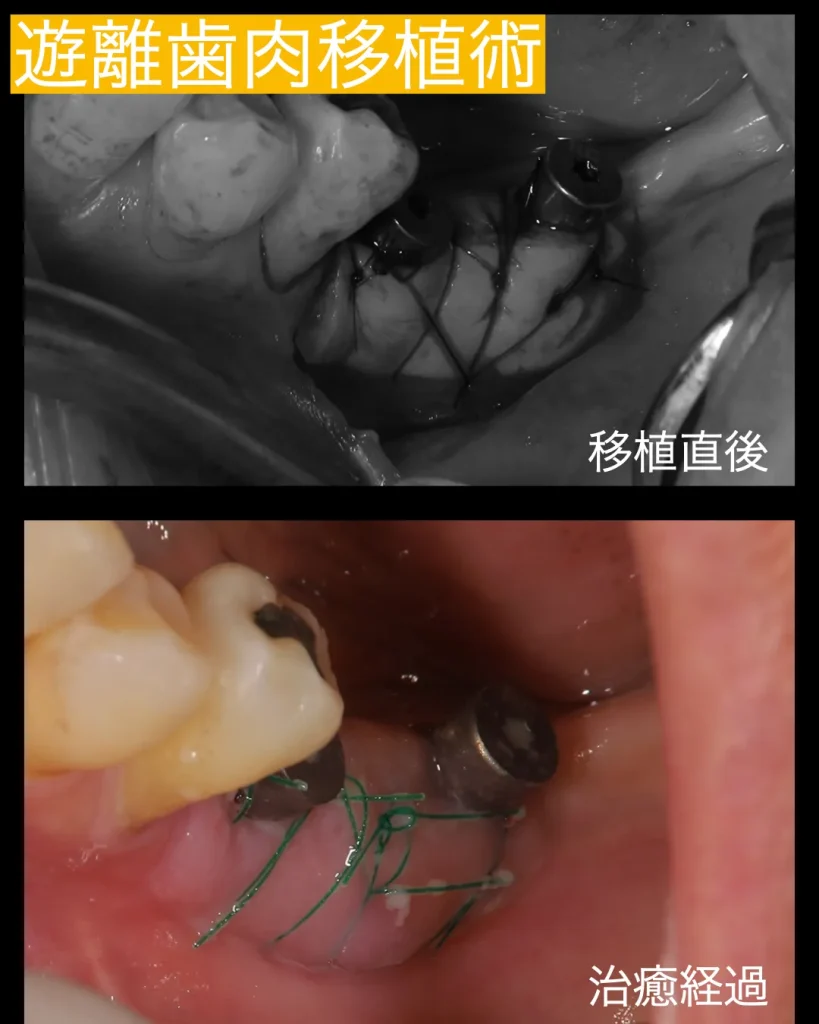 FGGの治療直後