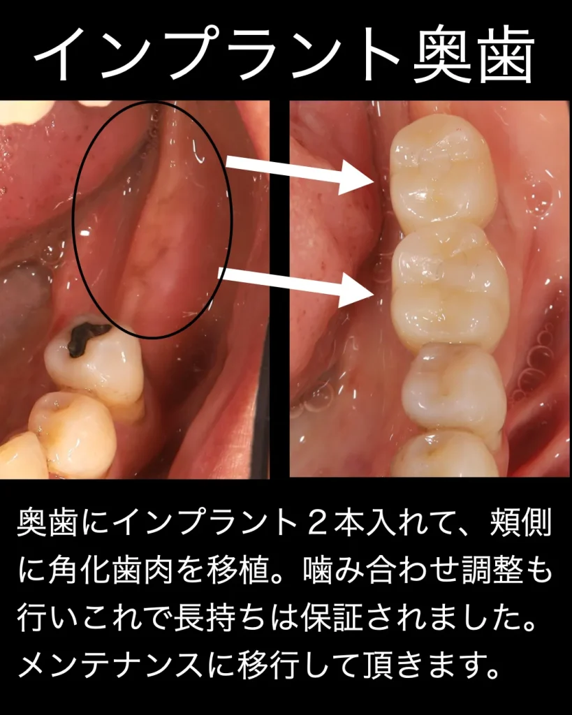 奥歯に2本のインプラントを入れて、頬側に角化歯肉を移植。