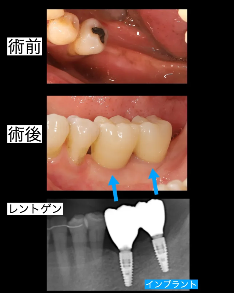 術前、術後、レントゲン