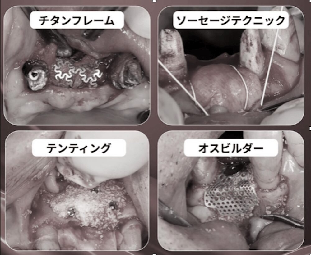 様々な骨造成の方法