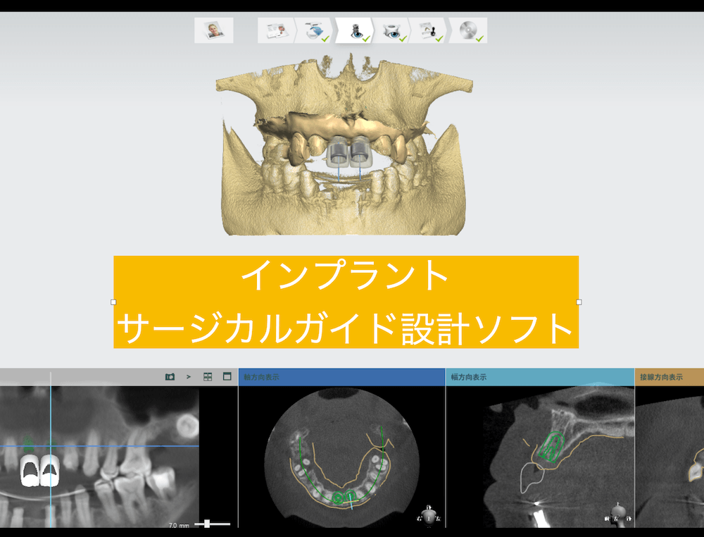 インプラントサージカルガイド設計ソフト