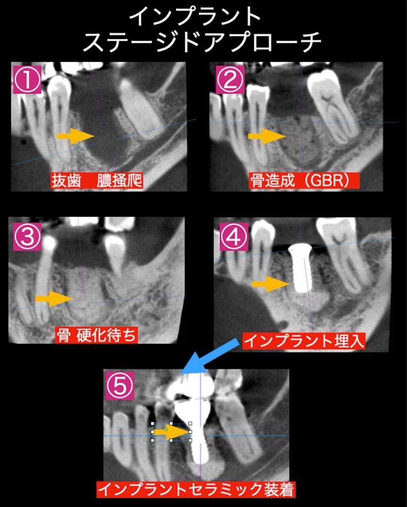 インプラントのステージドアプローチ