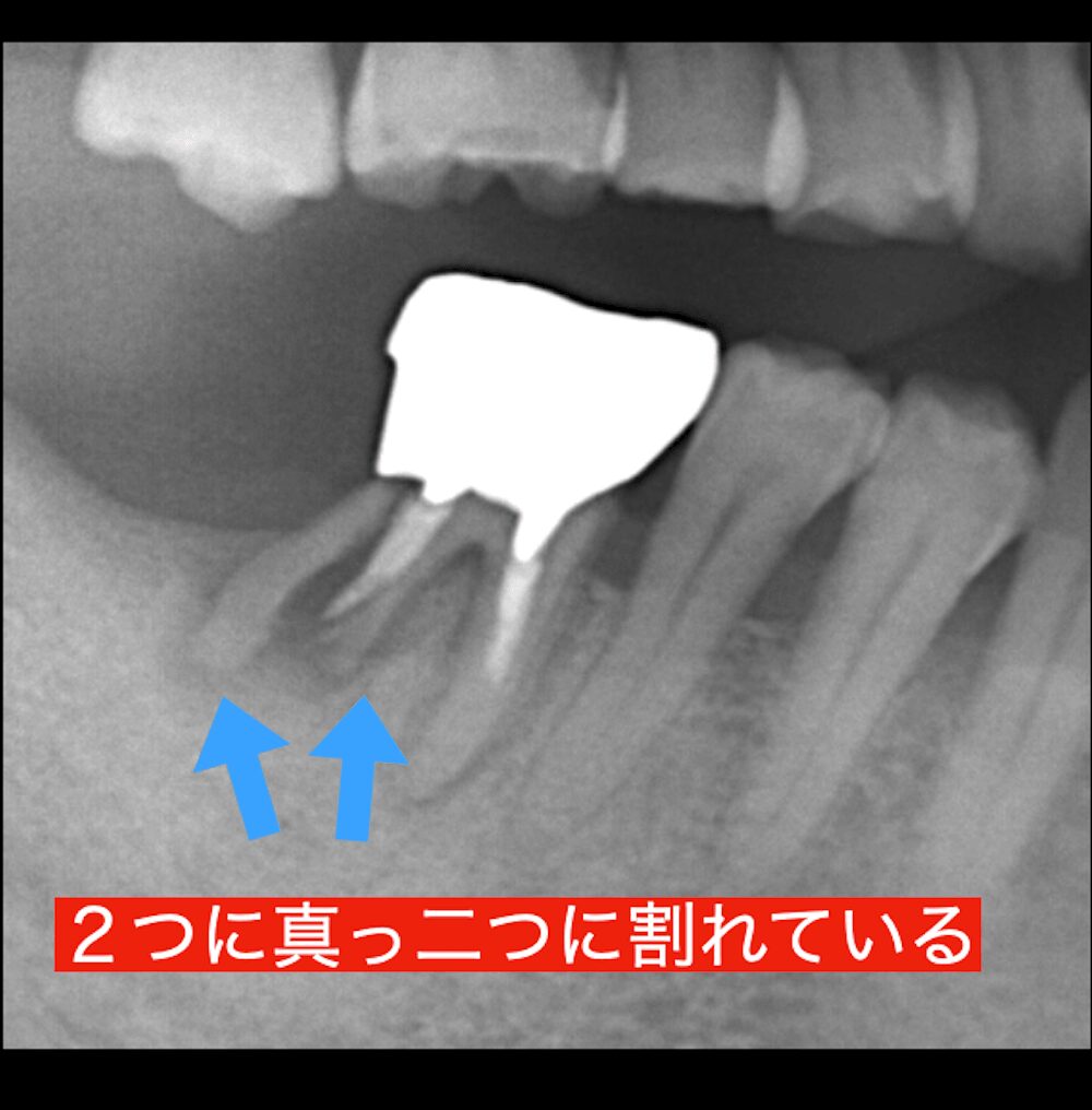 垂直破折で歯の根が真っ二つに割れている