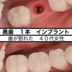 20年前に根管治療をしたが、歯が割れた。