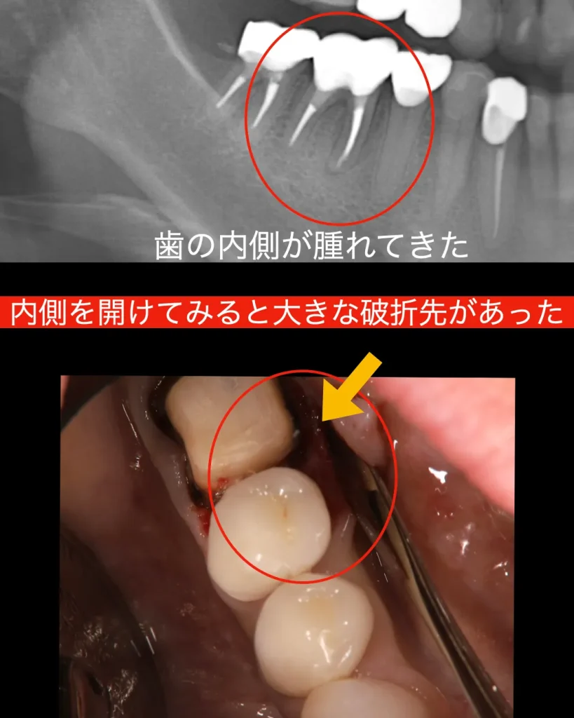 内側を開けてみると、大きな破折線があった