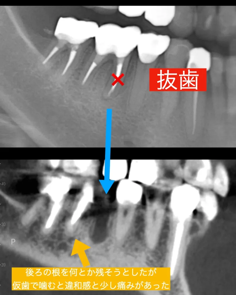 後ろの歯を何とか残そうとしたが、仮歯で噛むと違和感や少しの痛みがあった