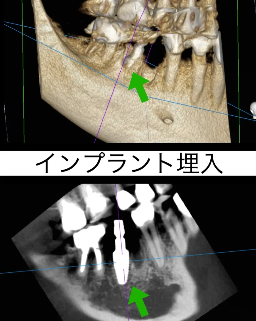 抜歯即時インプラントの埋入