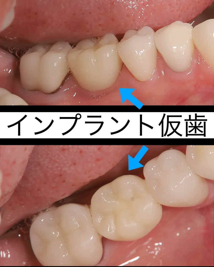 インプラントの仮歯