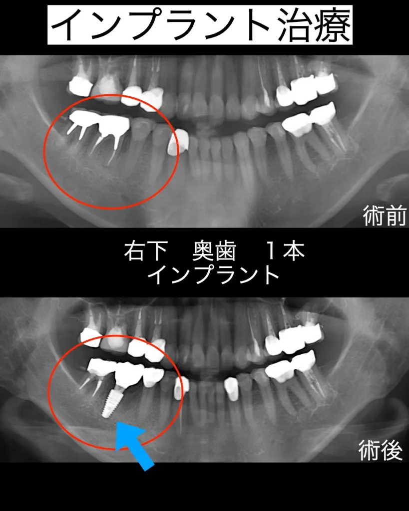 右下奥歯1本インプラントレントゲン画像