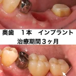 奥歯1本、インプラント、治療期間3ヶ月。