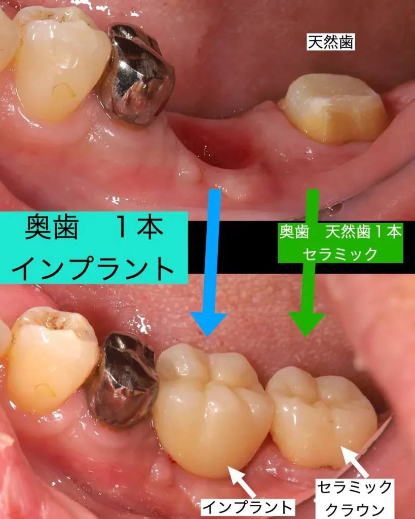 奥歯１本のインプラント治療と噛み合わせを整えしっかりと噛みたい
