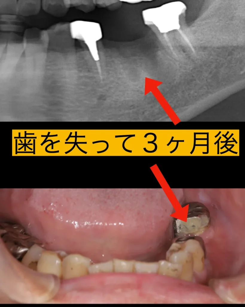 歯を失って3ヶ月後
