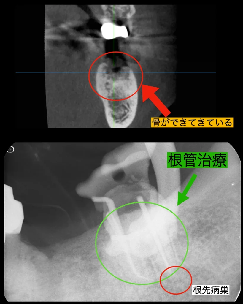 骨ができている様子。