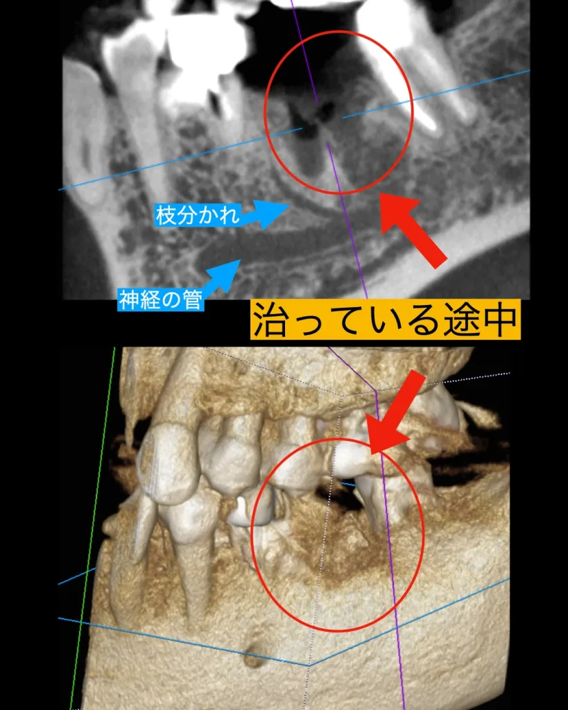 治っている途中