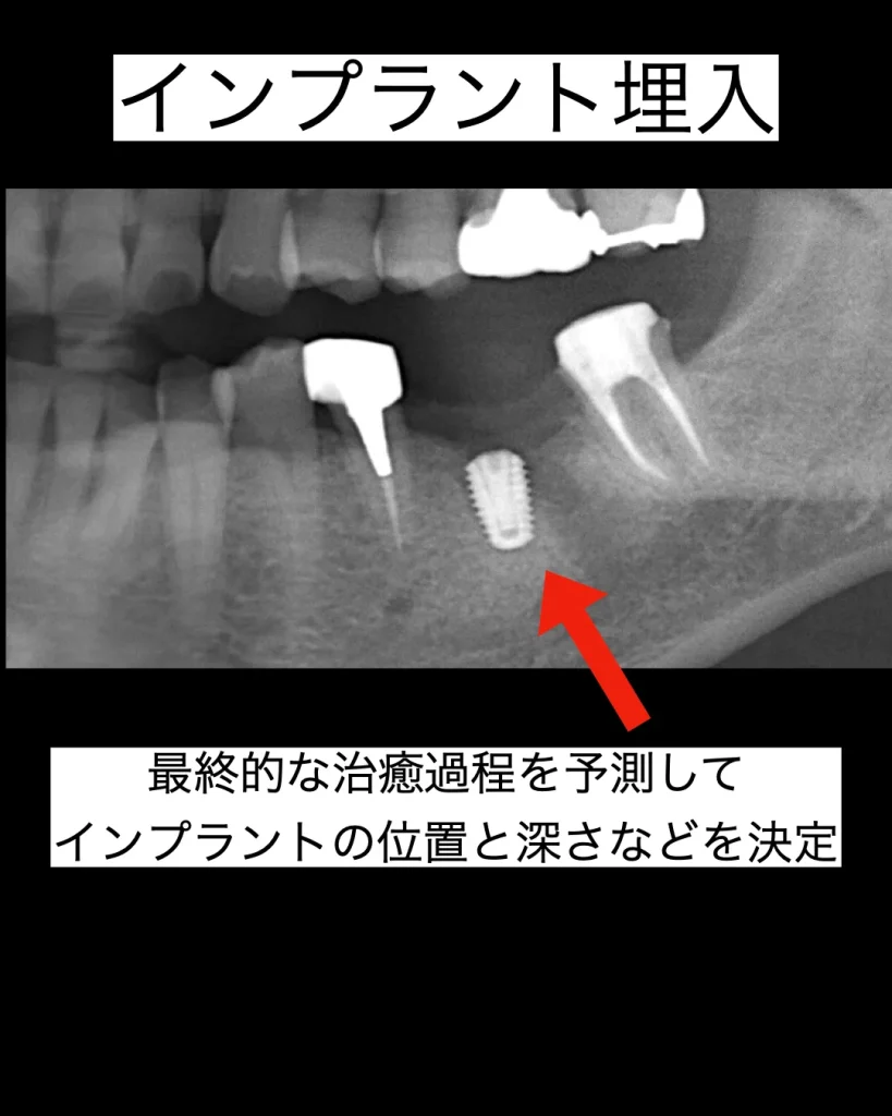 インプラント埋入