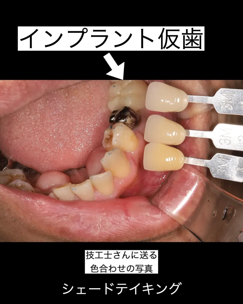 シェードテイキング