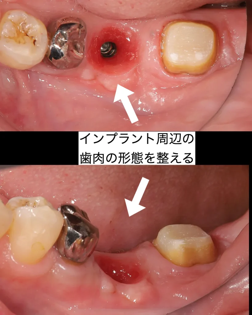 インプラント周辺の歯肉の形態を整える