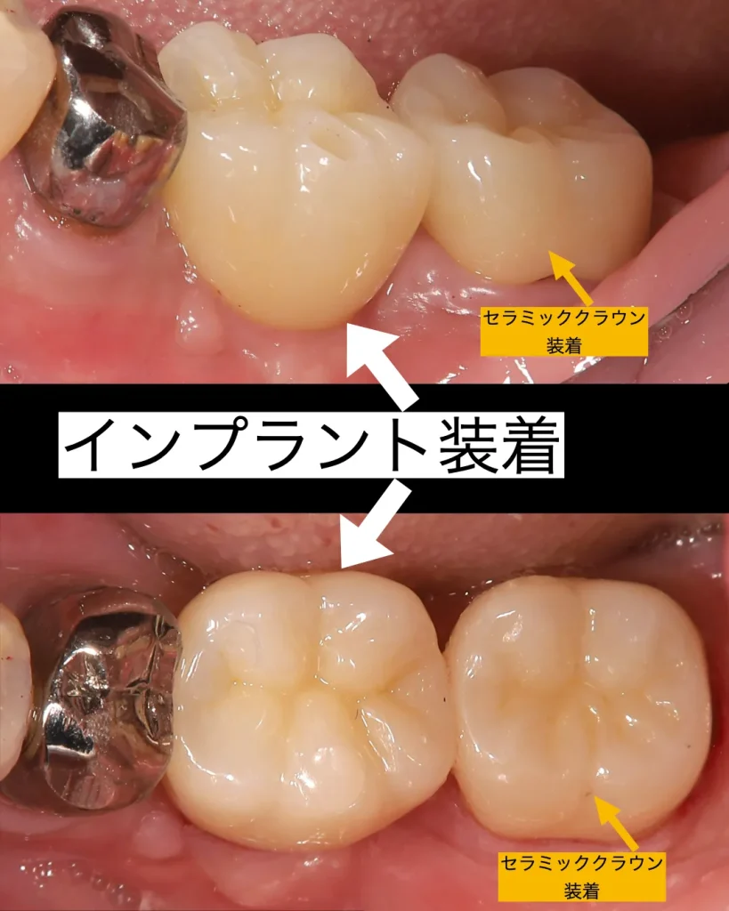 インプラント装着