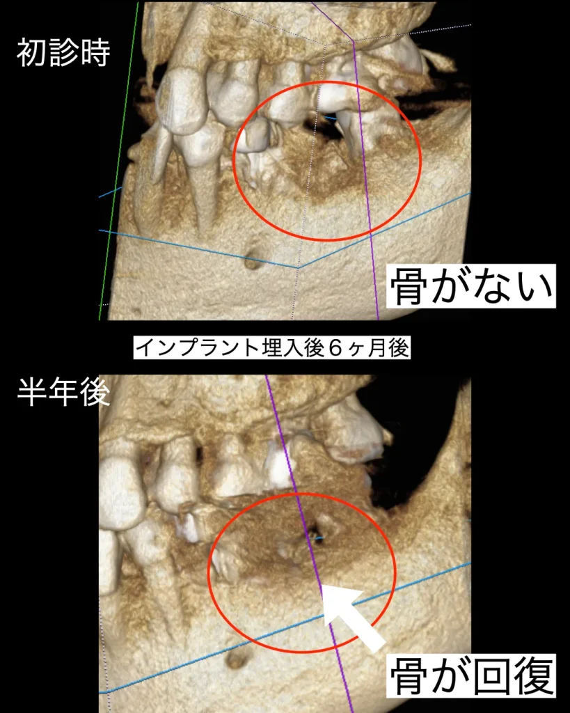 インプラント埋入半年後のCT画像