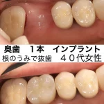 奥歯1本インプラント 根の治療後に抜歯 40代女性