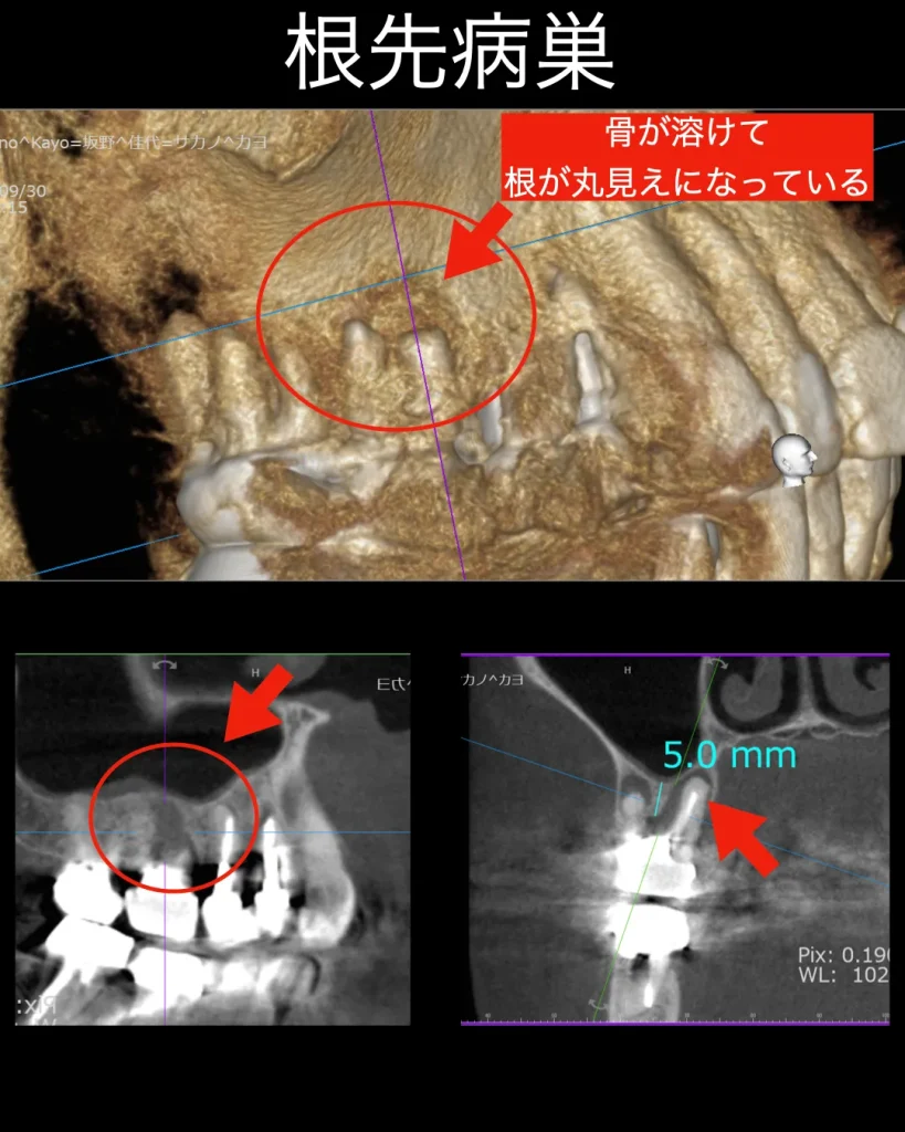 骨が溶けて、根が丸見えになっている