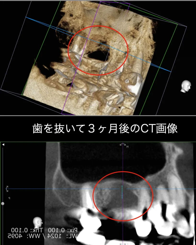 歯を抜いて3ヶ月後のCT画像