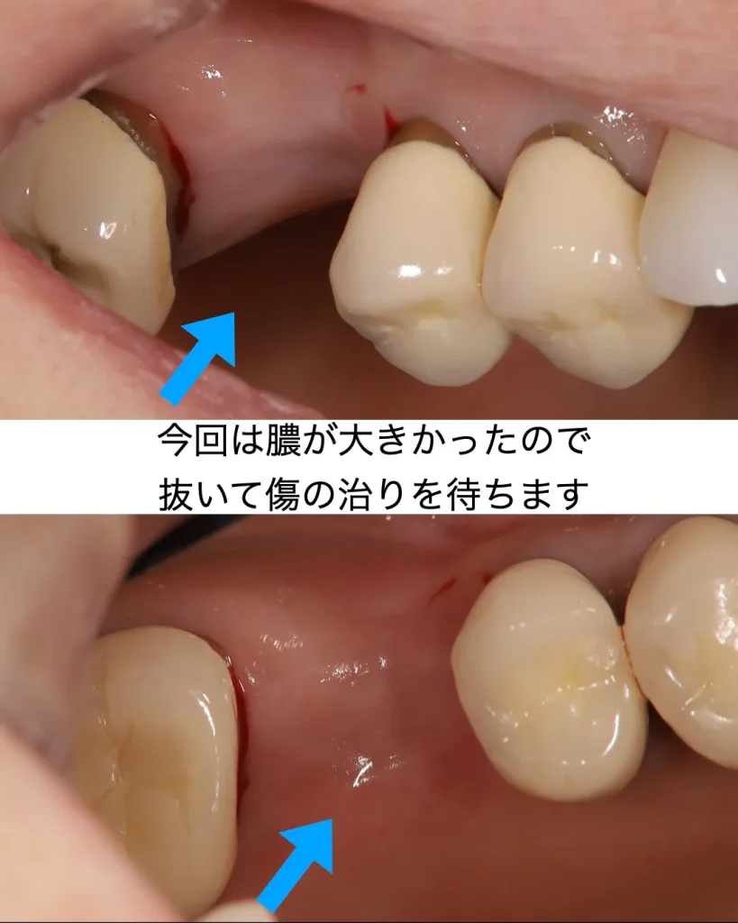 膿が大きかったので、抜いて傷の治りを待ちます