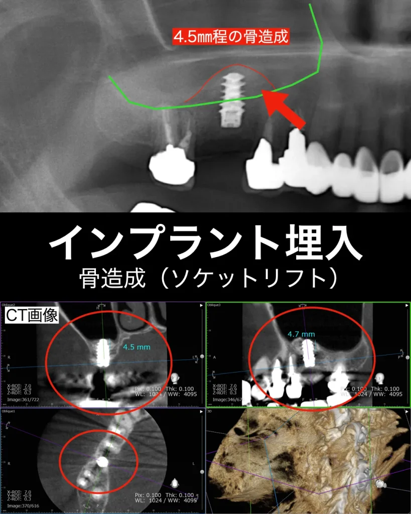インプラント埋入、骨造成、ソケットリフト