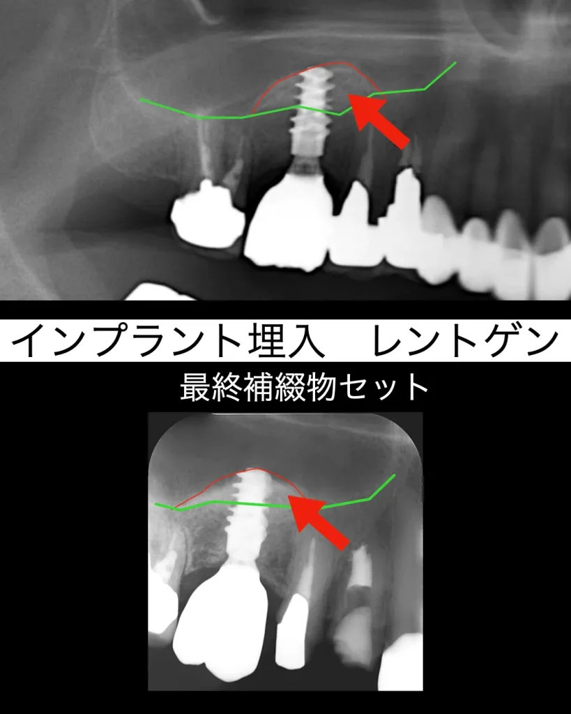 インプラント埋入時のレントゲン