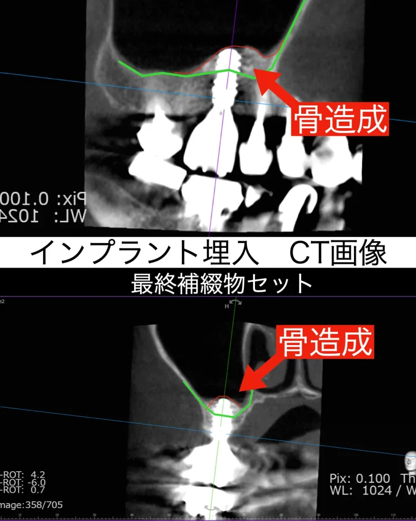 インプラント埋入時のCT画像