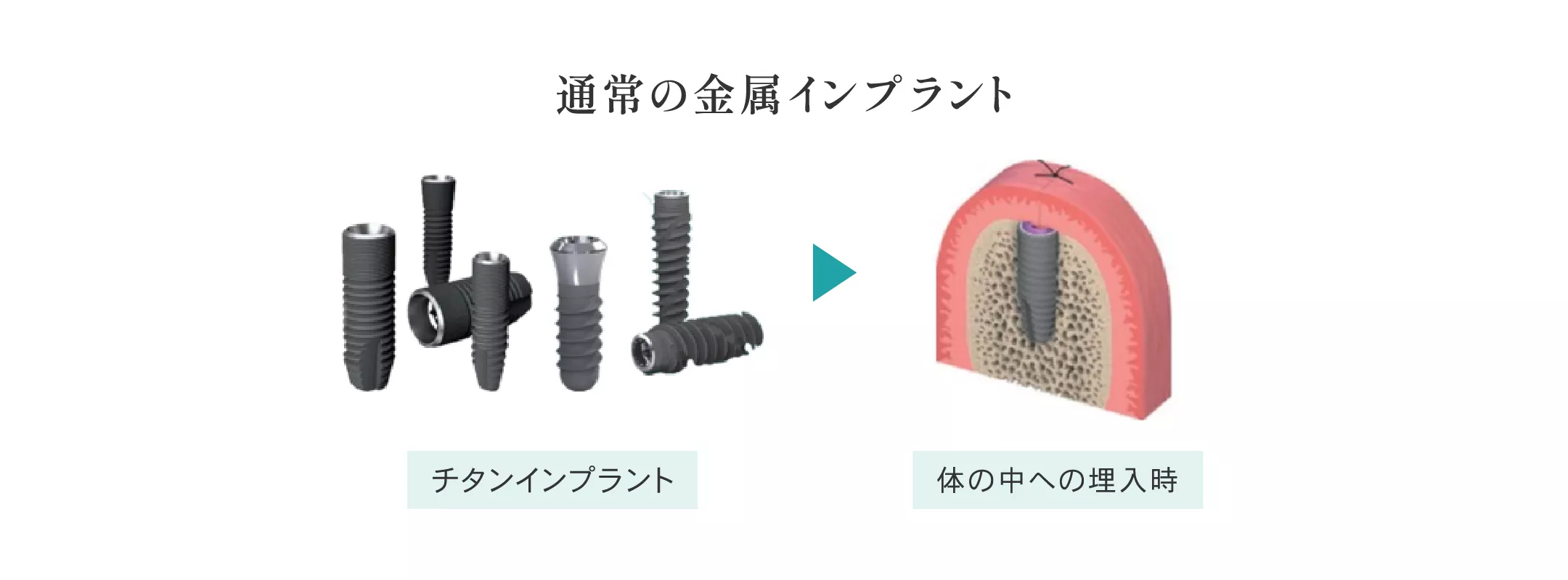 implant