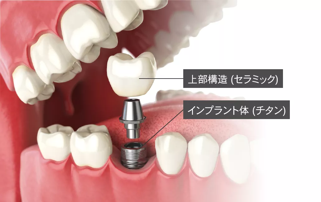 implant