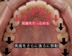 歯列矯正ブサイクになった・老け顔になった？15の原因とその対策 | 歯列矯正大阪でするなら「帝塚山スマイルデザインクリニック」