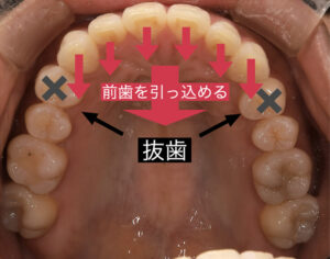【速報】 歯 列 矯正 ブサイク に なっ た 公式インスタ・X最新情報 #987