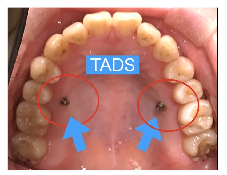 ④TADs（ミニスクリュー）を使用する場合