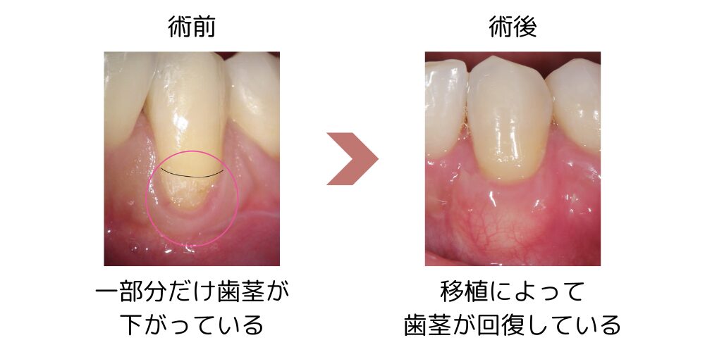 歯肉退縮を根面被覆術によって治療