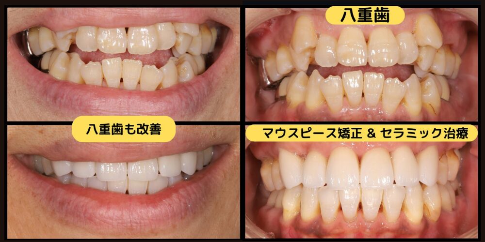 実際に当院で歯列矯正した50代の患者様の症例