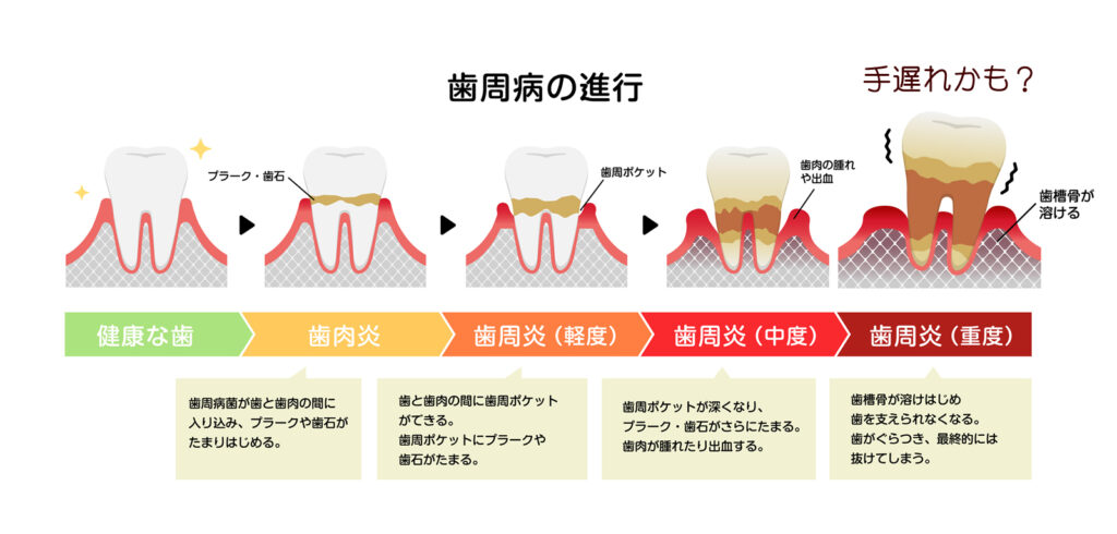 ① 歯周病手遅れかしれない５つの症状
