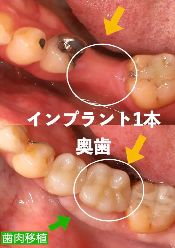 ②左下奥歯に1本インプラントを埋入した症例(歯肉移植あり)